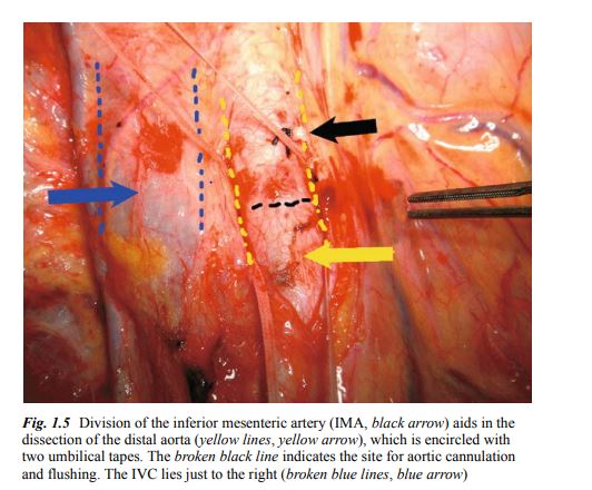 Atlas of Organ Transplantation PDF